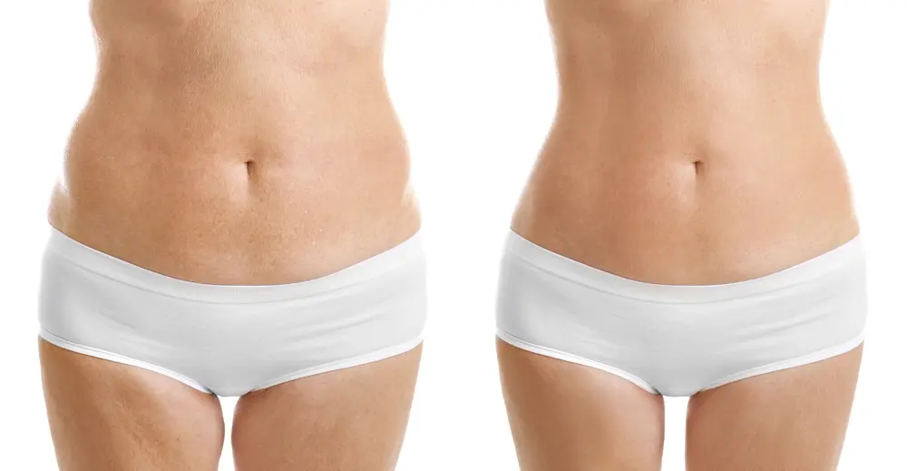 LASER LIPOSUCTION