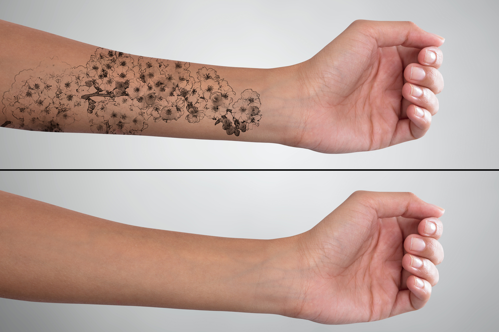 laser tattoo removal