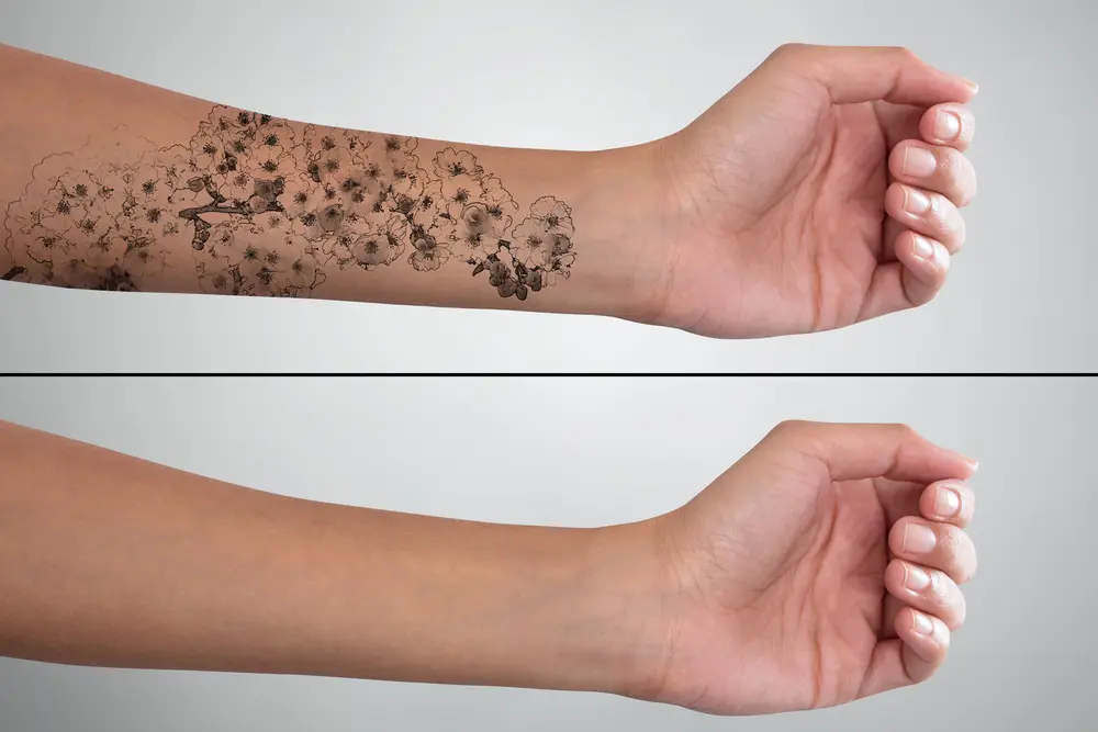 laser tattoo removal