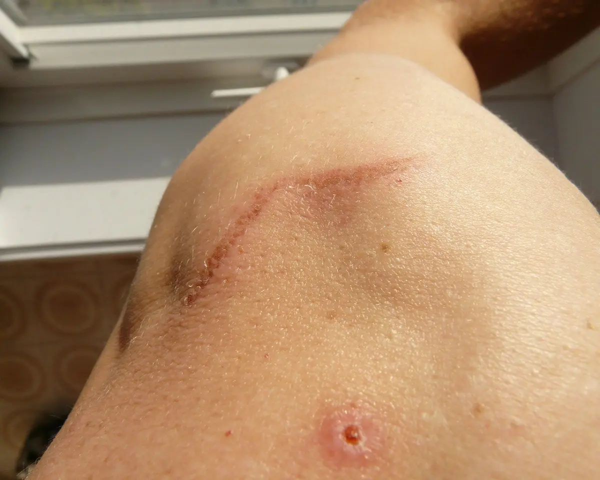 laser scar removal