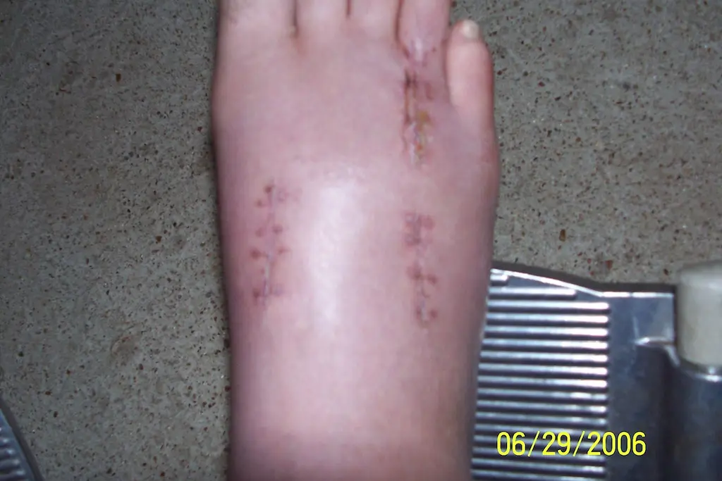 My Right Foot After Reconstructive Surgery