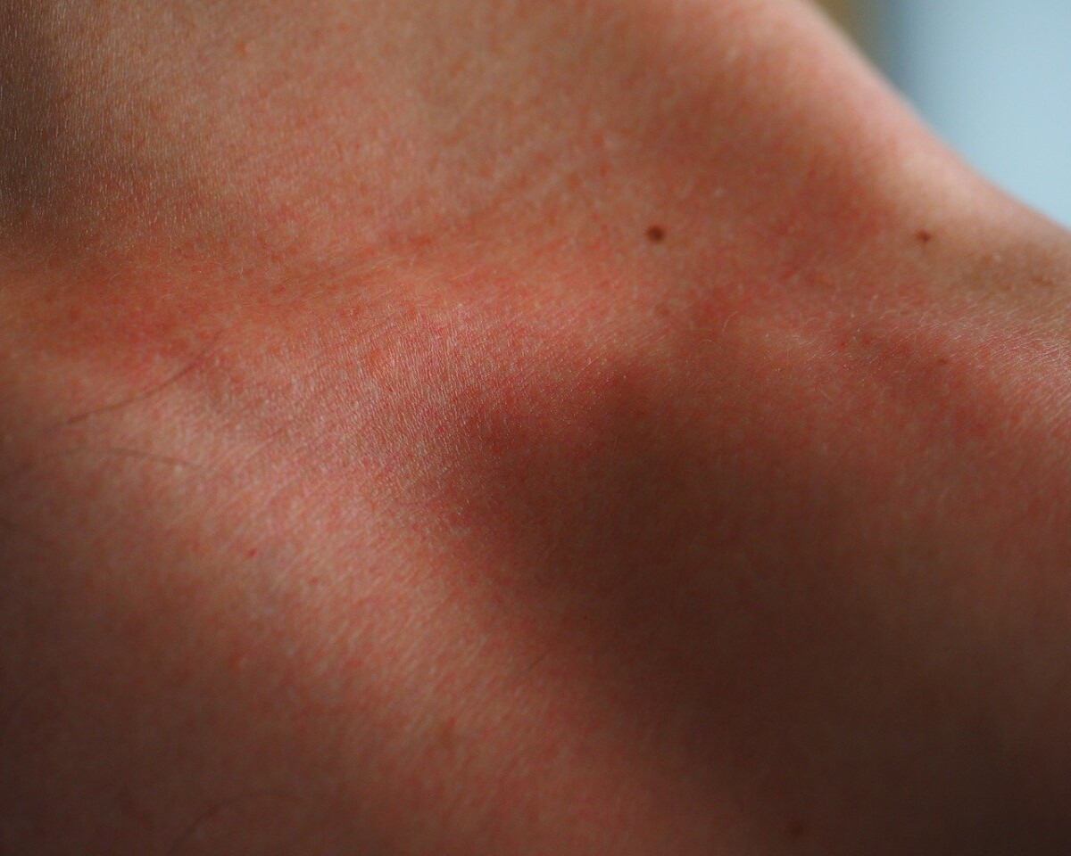 FAQs about Eczema Treatment