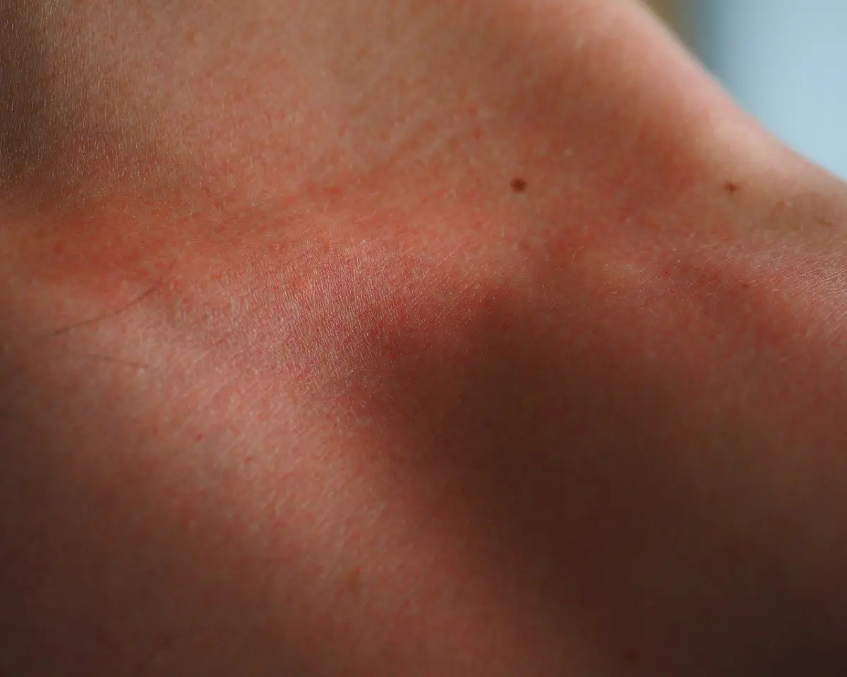 FAQs about Eczema Treatment