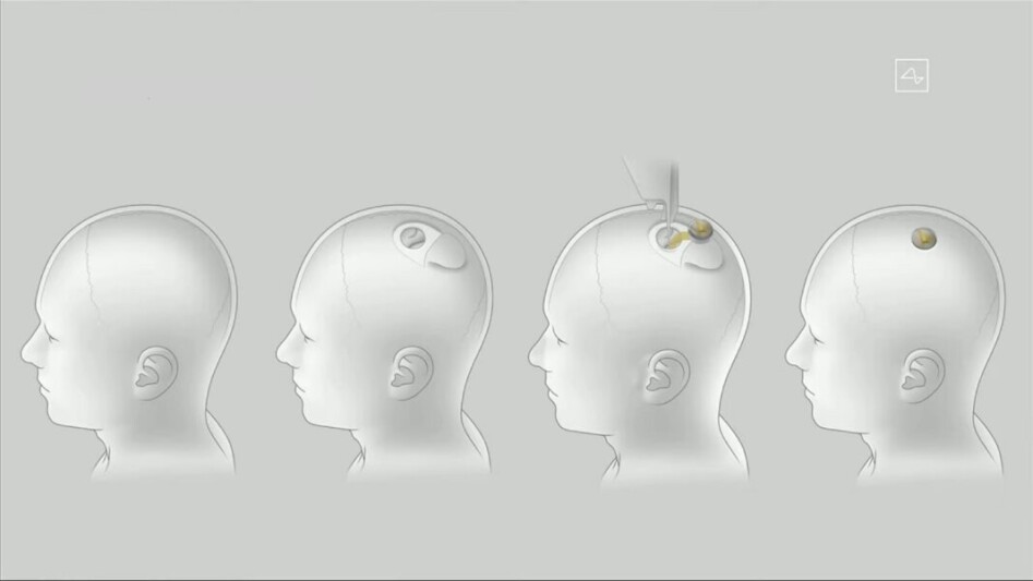 Neuralink Architecture