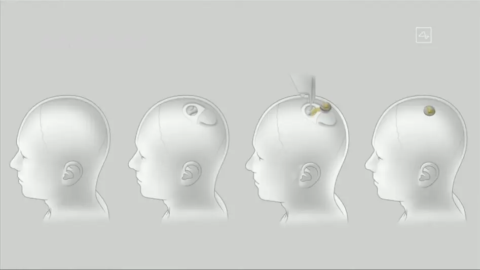 Neuralink Architecture