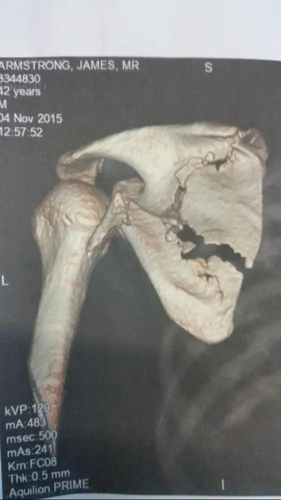 ET xray? Or my left shoulder?